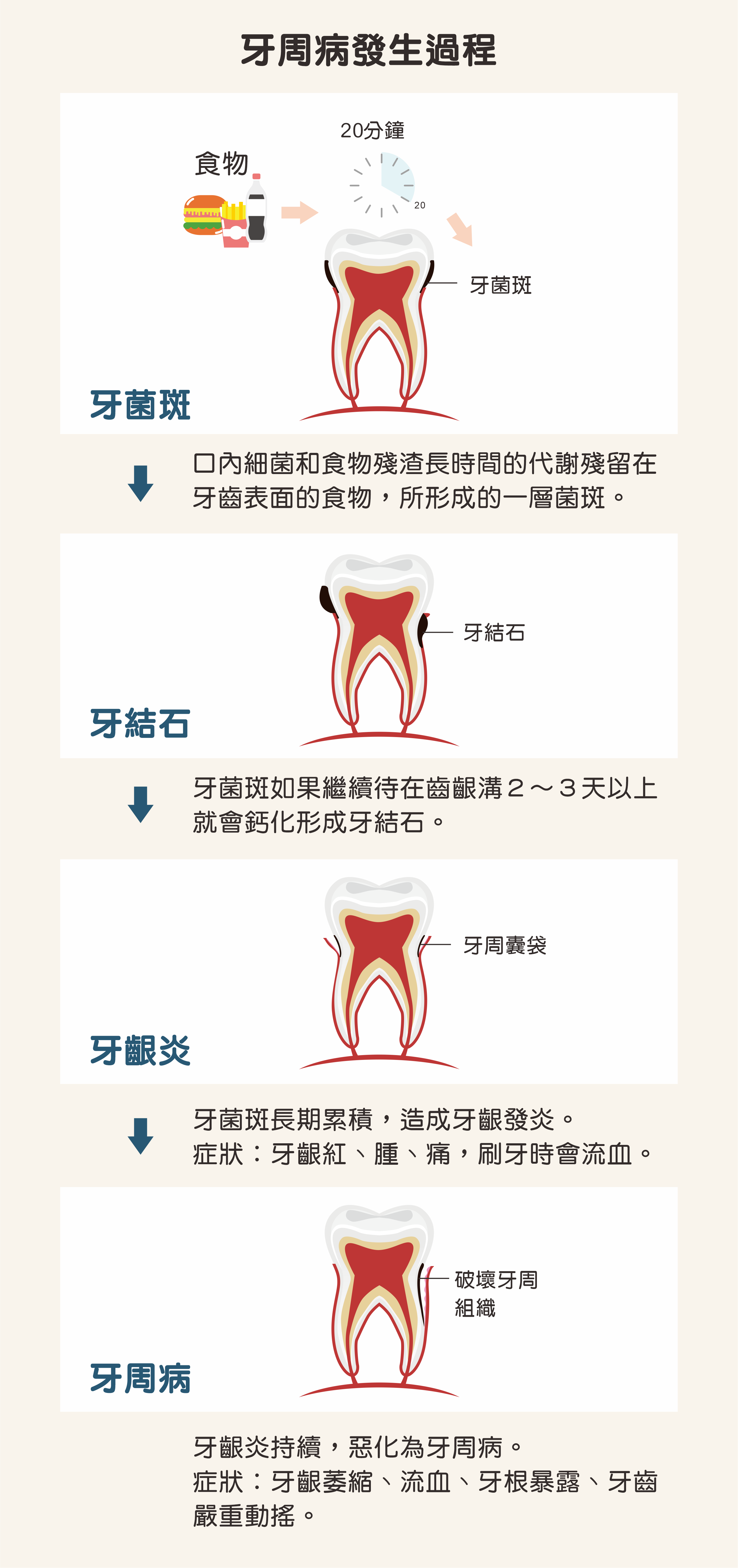 根管治療