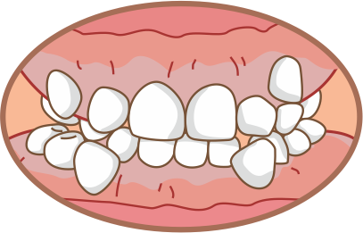1.齒列擁擠